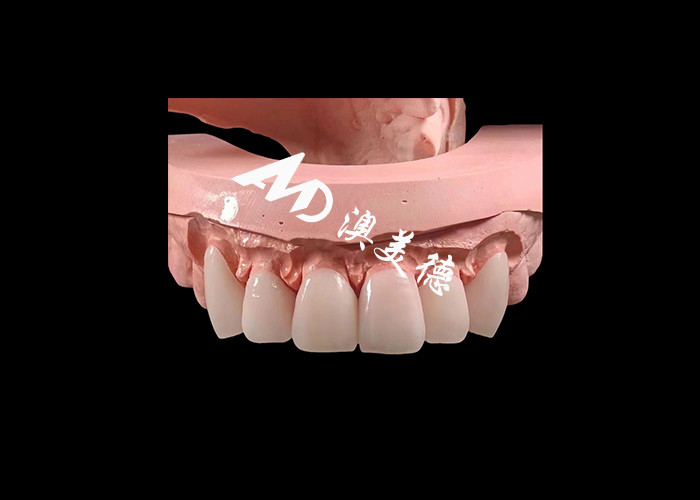 Kosmetik Kedokteran Gigi EMAX Dental veneers 0.3-0.5mm tebal Untuk restorasi estetika