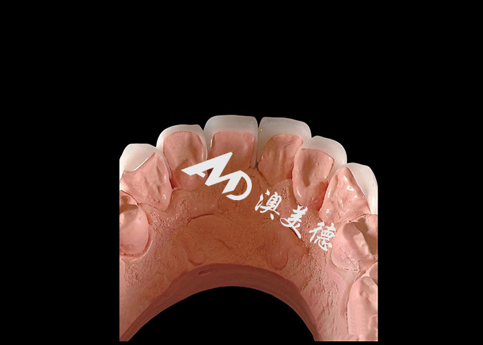 Kosmetik Kedokteran Gigi EMAX Dental veneers 0.3-0.5mm tebal Untuk restorasi estetika