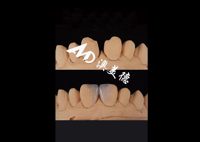 0.3-0.5mm Ultra tipis IPS EMAX Porselen Veneers untuk Estetika Smile Makeovers