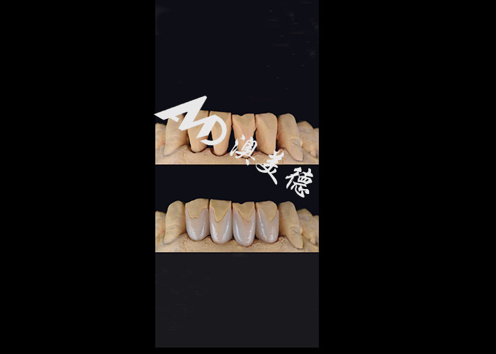 0.3-0.5mm Ultra tipis IPS EMAX Porselen Veneers untuk Estetika Smile Makeovers