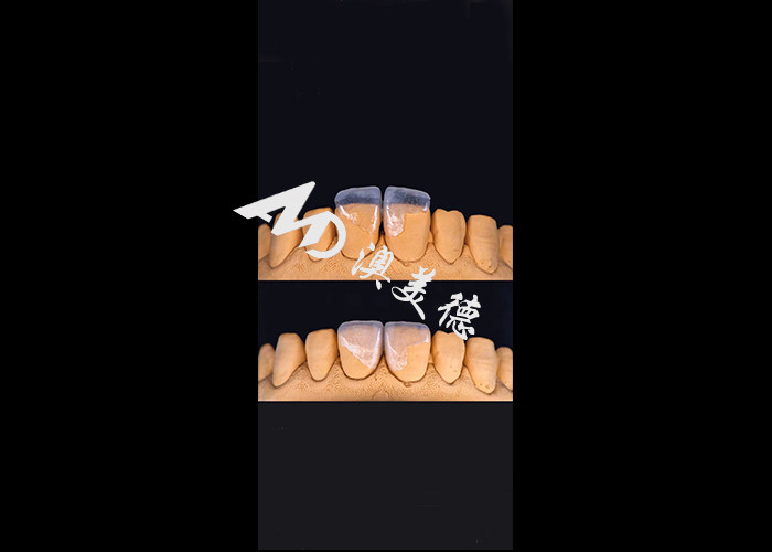 0.3-0.5mm Ultra tipis IPS EMAX Porselen Veneers untuk Estetika Smile Makeovers
