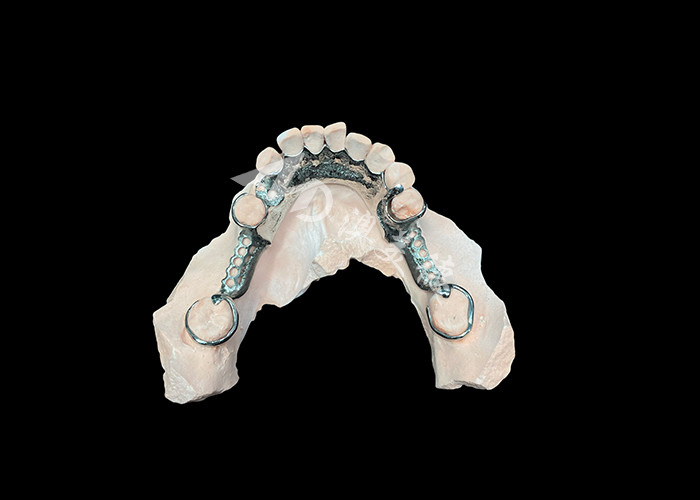 Dental parsial cast yang disesuaikan dengan estetika yang dipersonalisasi dan aman untuk kenyamanan dan fungsionalitas yang ditingkatkan