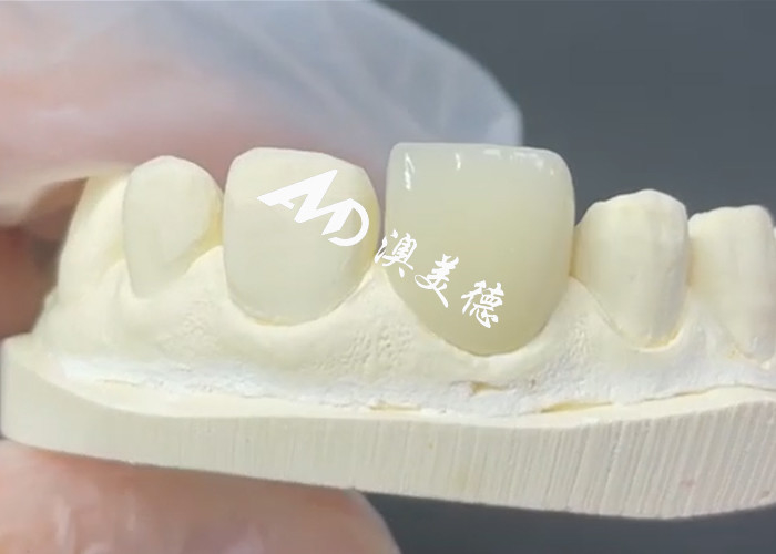 EMAX Veneer yang awet dan estetis Solusi yang Sempurna untuk Restorasi Porselen