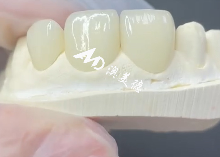 EMAX Veneer yang awet dan estetis Solusi yang Sempurna untuk Restorasi Porselen