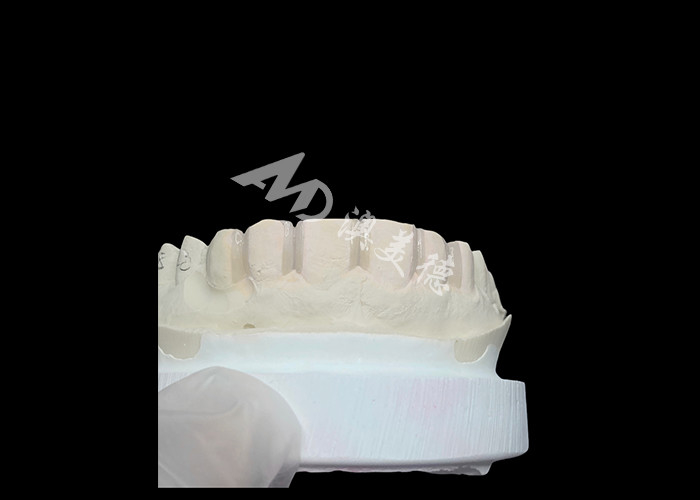 IPS Emax Veneers Minimal Prep/ No-prep Veneers adalah solusi inovatif untuk senyum yang indah