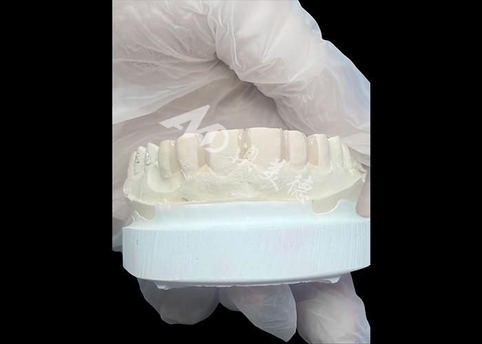 IPS Emax Veneers Minimal Prep/ No-prep Veneers adalah solusi inovatif untuk senyum yang indah