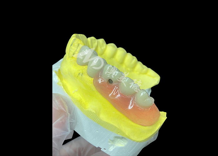 Personalize PFM + removable dentures combo Solusi Ultimate untuk kenyamanan dan estetika