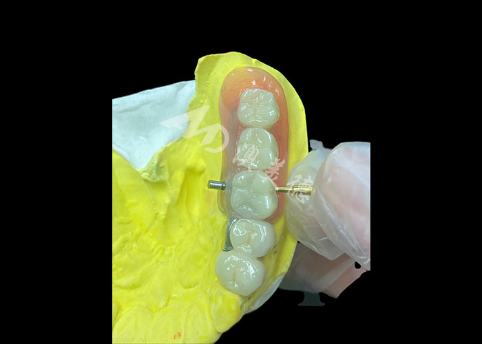 Personalize PFM + removable dentures combo Solusi Ultimate untuk kenyamanan dan estetika