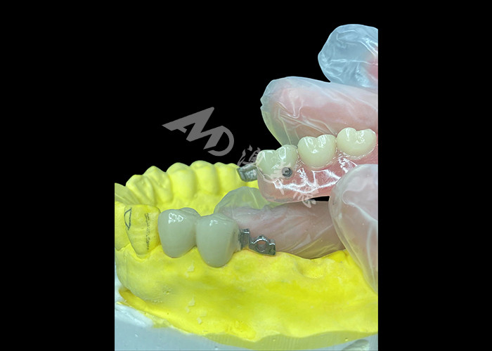 Personalize PFM + removable dentures combo Solusi Ultimate untuk kenyamanan dan estetika