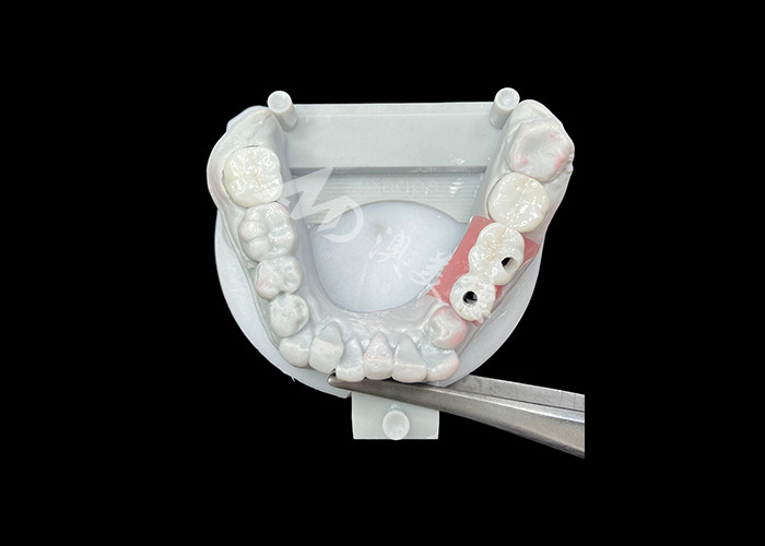 Mahkota Implantasi Gigi Zirconia Dengan Titanium Abutment Untuk Meningkatkan Kenyamanan Dan Estetika