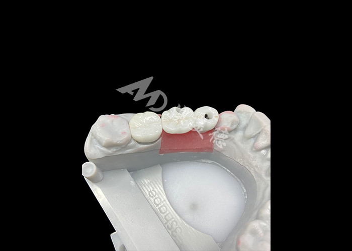 Mahkota Implantasi Gigi Zirconia Dengan Titanium Abutment Untuk Meningkatkan Kenyamanan Dan Estetika