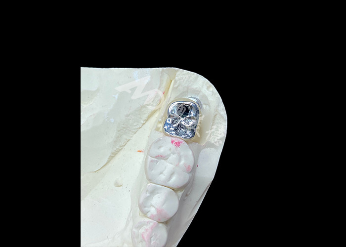 Mahkota Implan Gigi Dengan Titanium Abutment Dan Porselen-Melebur-ke-Metal PFM Mahkota