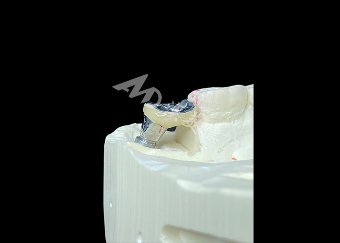Mahkota Implan Gigi Dengan Titanium Abutment Dan Porselen-Melebur-ke-Metal PFM Mahkota