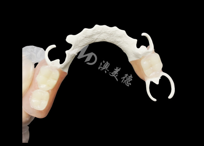 Custom Cast Partial Denture dengan kerangka HPP untuk meningkatkan mengunyah dan berbicara