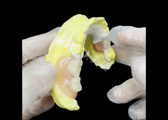 Custom Cast Partial Denture dengan kerangka HPP untuk meningkatkan mengunyah dan berbicara
