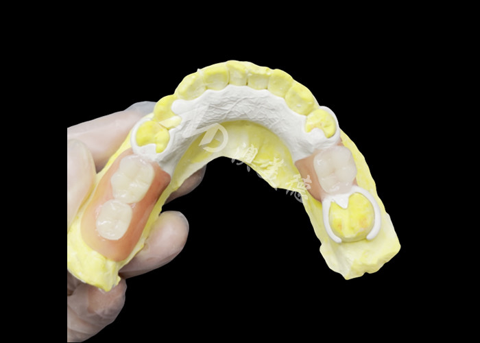 Custom Cast Partial Denture dengan kerangka HPP untuk meningkatkan mengunyah dan berbicara