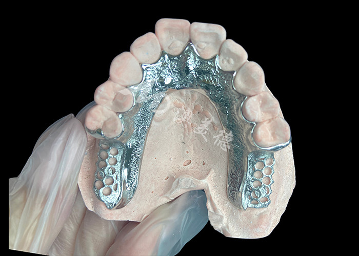 Custom Cast Partial Denture Dental Prothesis Frame Tanpa Gigi Disiapkan Untuk Stabilitas Dan Fungsi