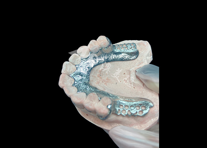 Custom Cast Partial Denture Dental Prothesis Frame Tanpa Gigi Disiapkan Untuk Stabilitas Dan Fungsi