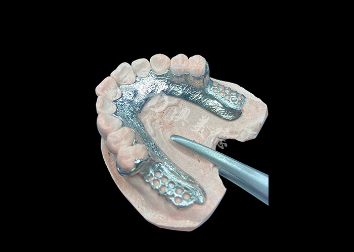 Custom Cast Partial Denture Dental Prothesis Frame Tanpa Gigi Disiapkan Untuk Stabilitas Dan Fungsi