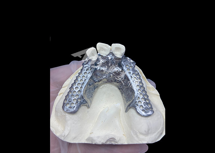 Easy Fit Custom Cast Partial Denture Frame yang stabil dan terlihat alami untuk hasil yang cepat