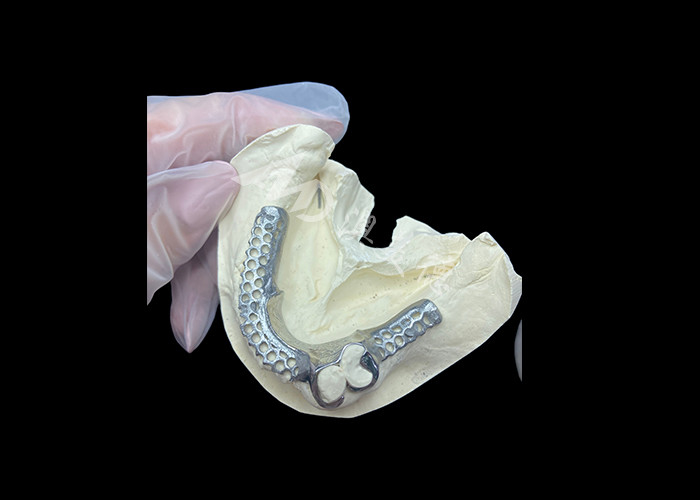 Easy Fit Custom Cast Partial Denture Frame yang stabil dan terlihat alami untuk hasil yang cepat
