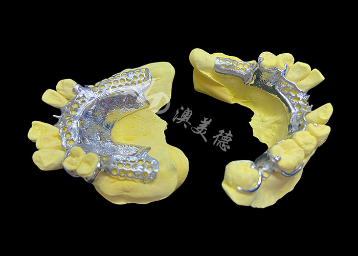 Custom Cast Partial Denture Solusi terlihat alami untuk peningkatan kenyamanan dan bicara