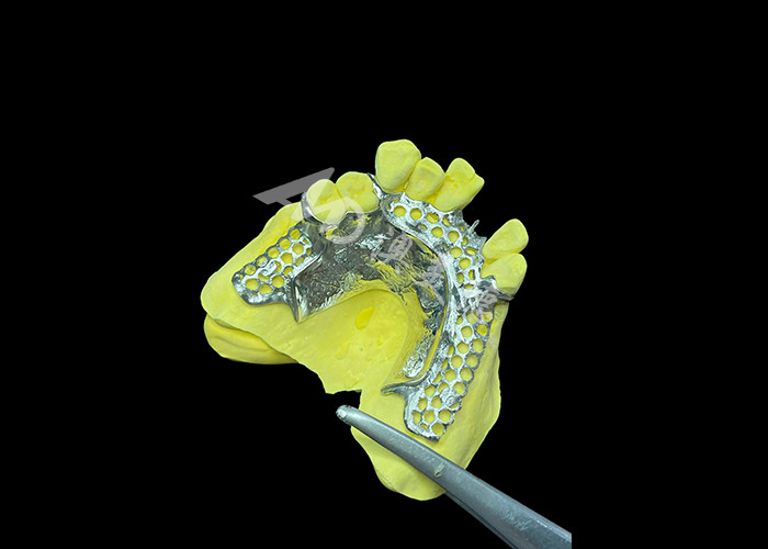 Custom Cast Partial Denture Solusi terlihat alami untuk peningkatan kenyamanan dan bicara