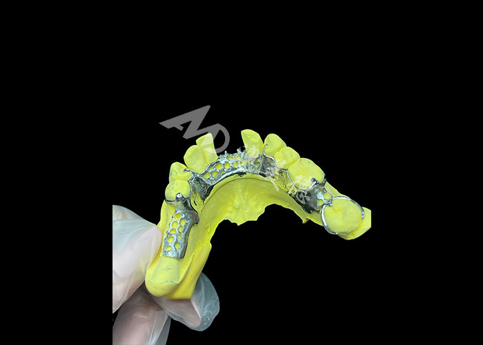 Custom Cast Partial Denture Solusi terlihat alami untuk peningkatan kenyamanan dan bicara