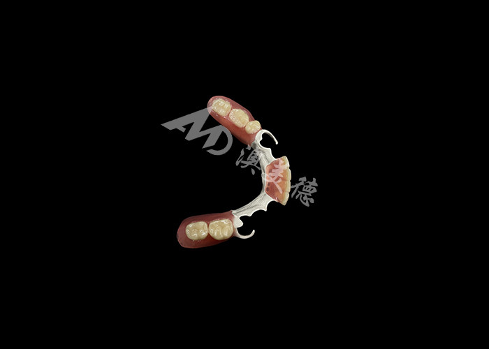 Custom Made Durable Cast Partial Dentures With Hpp Frame Untuk Memulihkan Senyum Anda