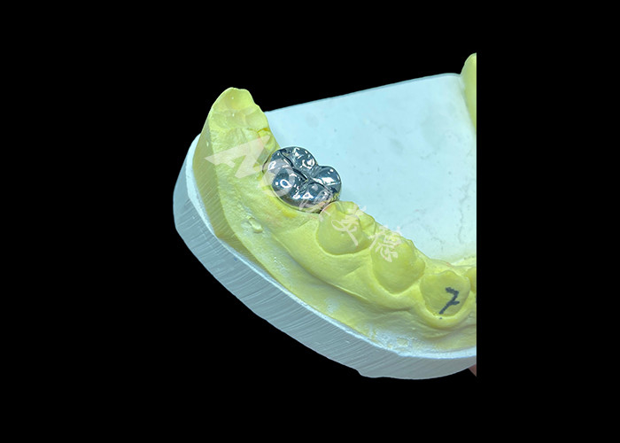 Fungsi tahan lama Crown Cast Full Metal yang tahan lama untuk restorasi gigi yang unggul