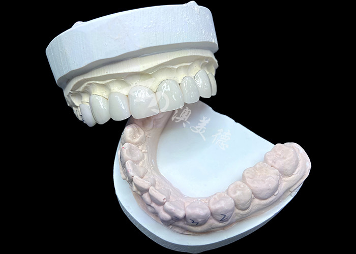 IPS e.max Veneers di Bayangan BL2 Mencapai Keindahan Alam yang Luar Biasa dengan 8 Unit yang Sempurna