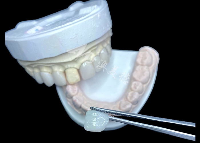 IPS e.max Veneers di Bayangan BL2 Mencapai Keindahan Alam yang Luar Biasa dengan 8 Unit yang Sempurna