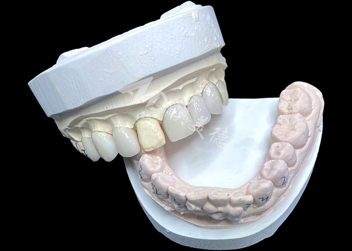 IPS e.max Veneers di Bayangan BL2 Mencapai Keindahan Alam yang Luar Biasa dengan 8 Unit yang Sempurna