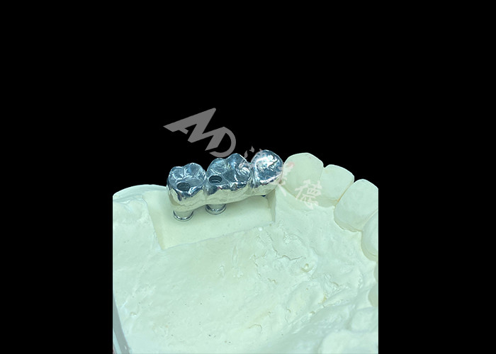 Implan Gigi Titanium Crown yang tahan lama untuk penggantian gigi yang hilang