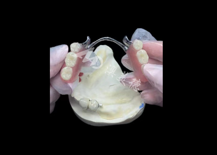 Porselen tahan lama yang dilebur ke logam Dental Crown PFM Crown Untuk Restorasi