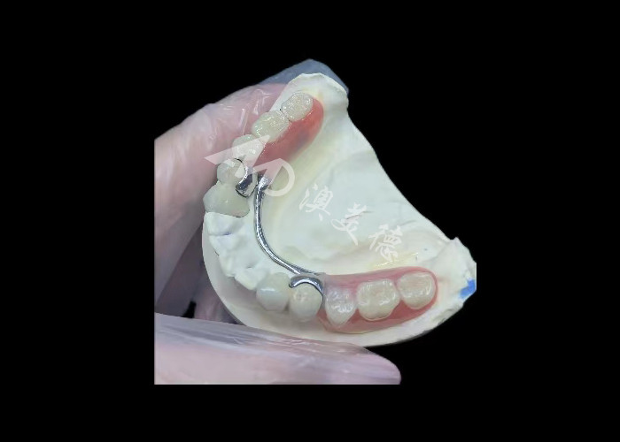 Porselen tahan lama yang dilebur ke logam Dental Crown PFM Crown Untuk Restorasi