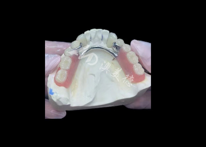 Porselen tahan lama yang dilebur ke logam Dental Crown PFM Crown Untuk Restorasi