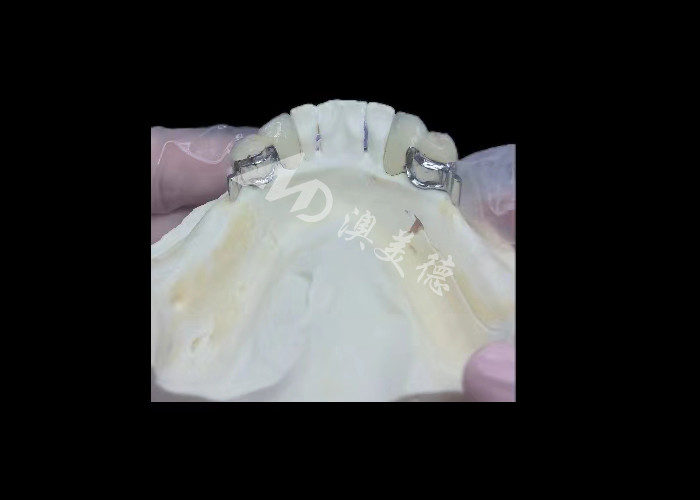 Porselen tahan lama yang dilebur ke logam Dental Crown PFM Crown Untuk Restorasi