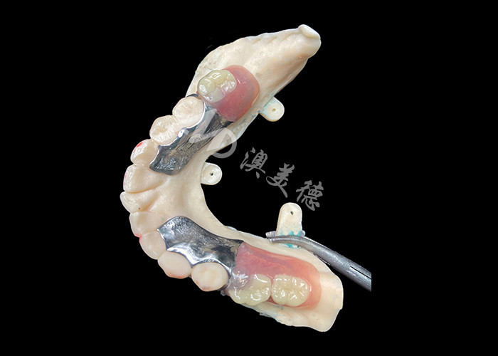 Dentitas Parsial Cast Customized Kerangka logam presisi untuk fit dan fungsi optimal