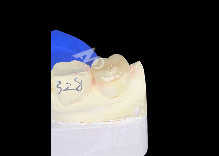 IPS E.max Keramik Inlays Onlays Seamless Blend Natural Looking Dan awet Dengan Gigi Anda