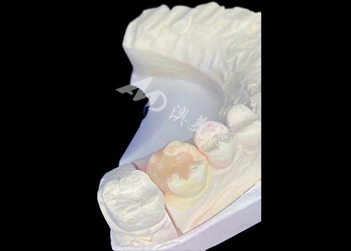 IPS e.max Keramik Inlays dan Onlays untuk restorasi molar dengan efek estetika dan penampilan alami yang tahan lama