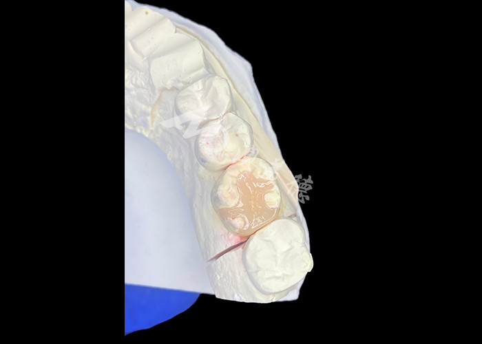 IPS e.max Keramik Inlays dan Onlays untuk restorasi molar dengan efek estetika dan penampilan alami yang tahan lama