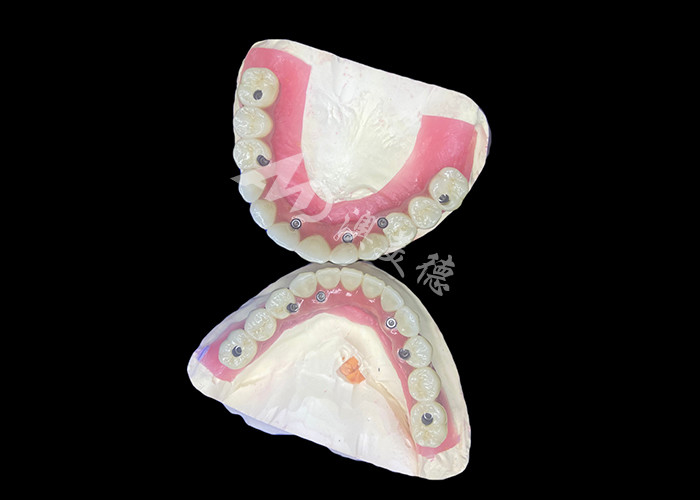 Dental All-on-6 Dental Implant Dukungan Gigi Dengan Stabilitas Dan Kenyamanan