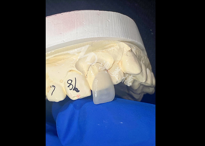 IPS e.max Veneers untuk pisau pisau pisau pisau pisau pisau pisau pisau pisau pisau pisau pisau pisau pisau pisau pisau pisau pisau pisau pisau pisau pisau pisau pisau pisau pisau pisau pisau pisau pisau pisau pisau pisau pisau pisau pisau pisau pisau pisau pisau pisau pisau pisau pisau pisau pisau pisau pisau pisau pisau pisau pisau pisau pisau pisau pisau pisau pisau pisau pisau pisau pisau pisau
