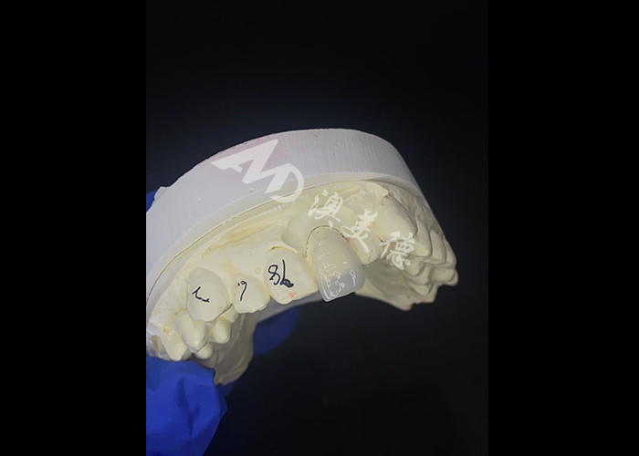 IPS e.max Veneers untuk pisau pisau pisau pisau pisau pisau pisau pisau pisau pisau pisau pisau pisau pisau pisau pisau pisau pisau pisau pisau pisau pisau pisau pisau pisau pisau pisau pisau pisau pisau pisau pisau pisau pisau pisau pisau pisau pisau pisau pisau pisau pisau pisau pisau pisau pisau pisau pisau pisau pisau pisau pisau pisau pisau pisau pisau pisau pisau pisau pisau pisau pisau pisau