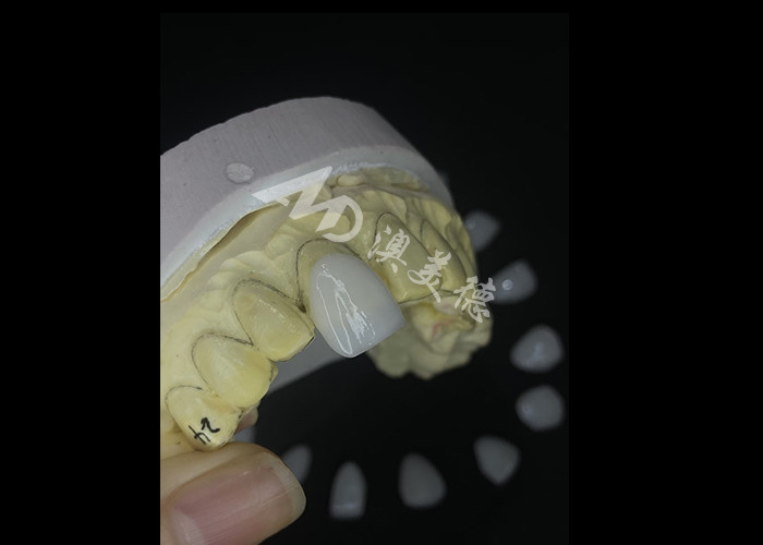 Precision Crafted IPS e.max Veneers untuk transformasi senyum yang tak tertandingi memberikan estetika ketahanan yang luar biasa