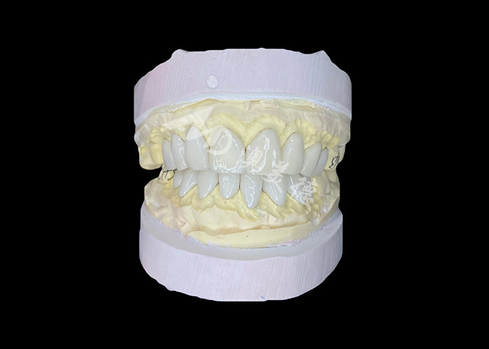Precision Crafted IPS e.max Veneers untuk transformasi senyum yang tak tertandingi memberikan estetika ketahanan yang luar biasa