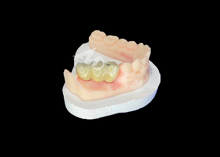 PFM Dental Crowns Lifelike and Corrosion Resistant untuk Kesehatan Oral yang Optimal