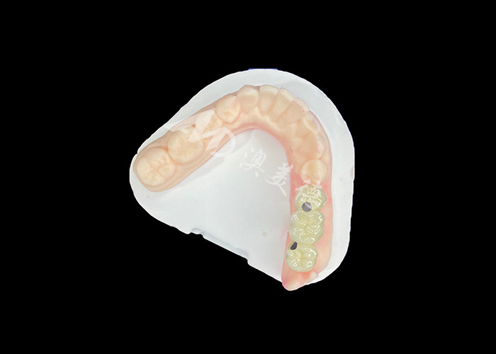 PFM Dental Crowns Lifelike and Corrosion Resistant untuk Kesehatan Oral yang Optimal