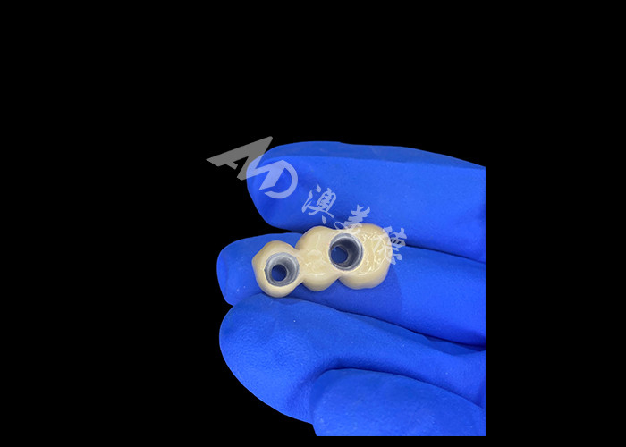 PFM Dental Crowns Lifelike and Corrosion Resistant untuk Kesehatan Oral yang Optimal